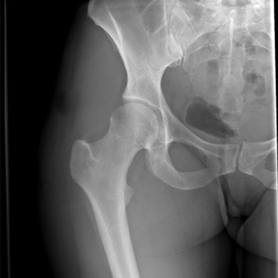 X-ray Left Femur/Thigh - Hip AP View