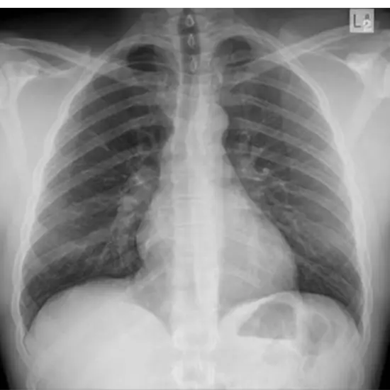 x-ray chest ap/lateral