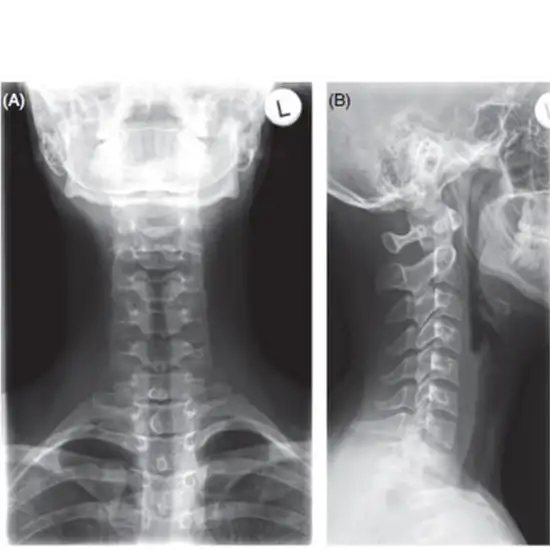 Xray Cervical Spine AP View Test Price in Delhi Ganesh Diagnostic