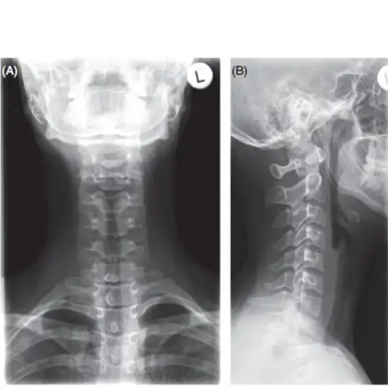 X-ray Cervical Spine AP View