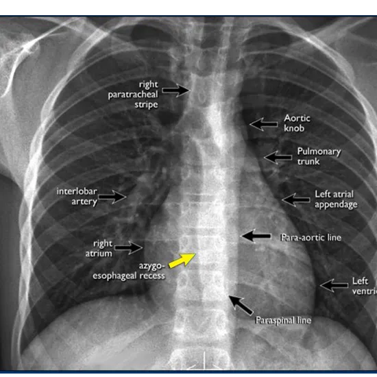 X-RAY Chest