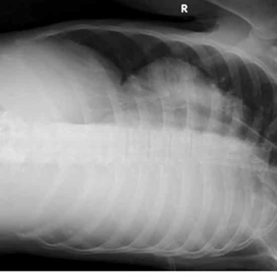 X-ray Chest Decubitus Right