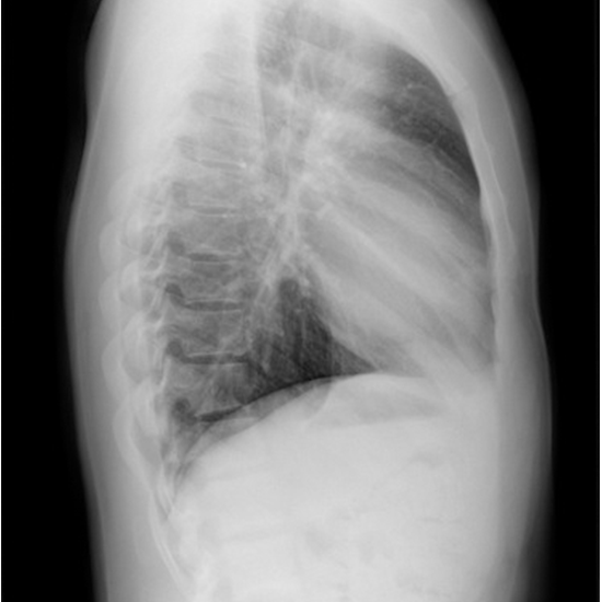 X-Ray Chest Lateral View
