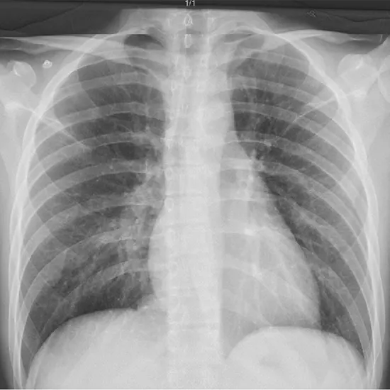 x-ray chest right oblique view