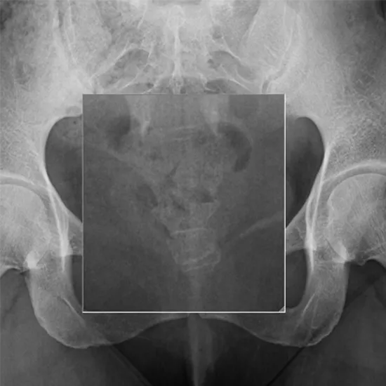X-Ray Coccyx AP/Lateral View