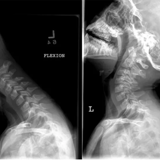 x-ray cervical spine flexion & extension