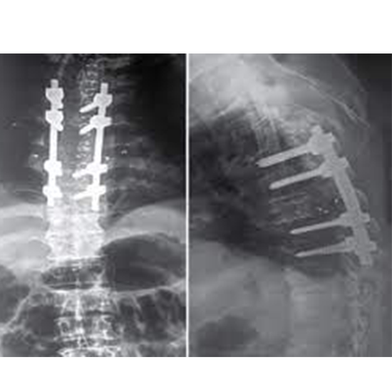 X-ray Dorsal Lumbar Spine AP/Lat