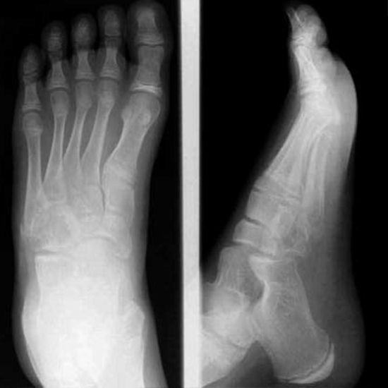 X-ray Left Foot AP/LAT/Oblique