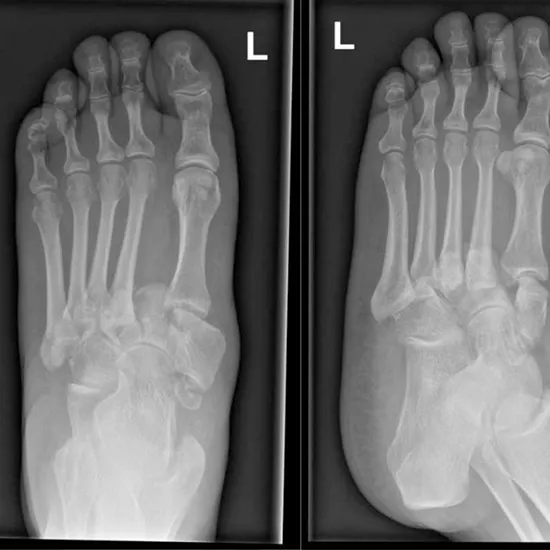 X-ray Left Foot AP & Lat