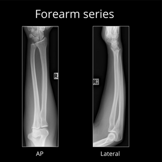 X-ray Left Forearm AP/Lateral