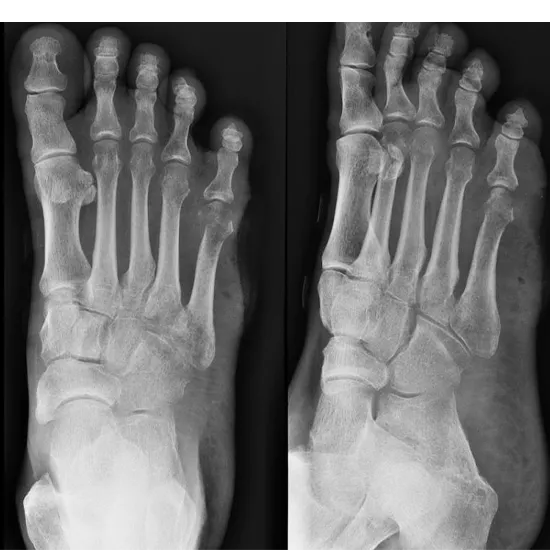 X-ray Left Foot AP/Oblique