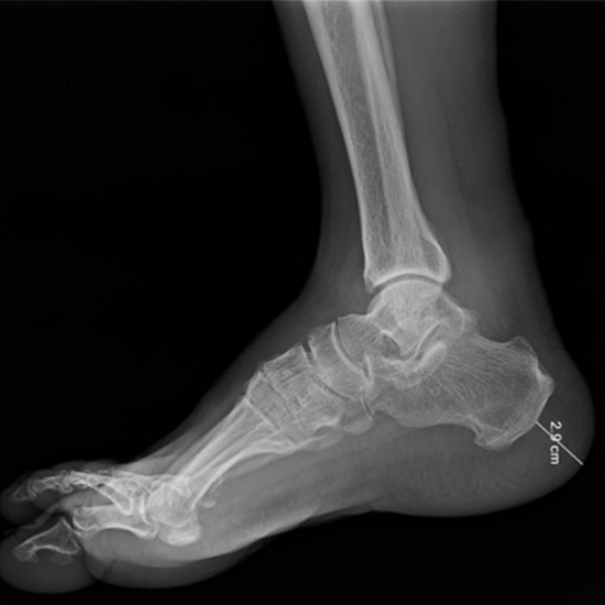 X-ray Left Heel