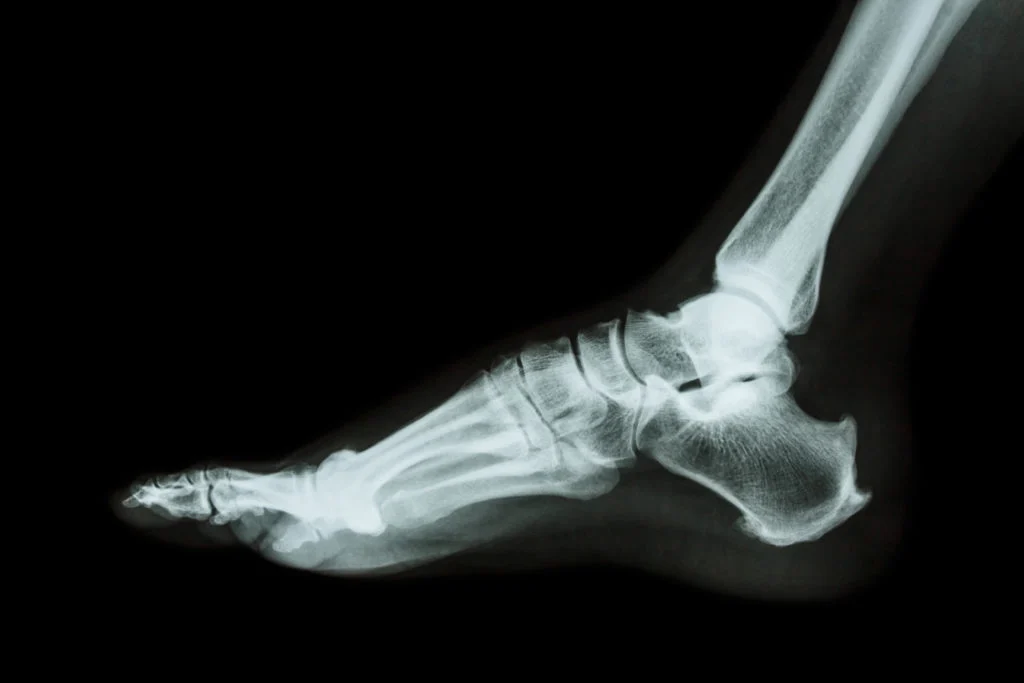 X-ray Left Heel AP & Lateral View