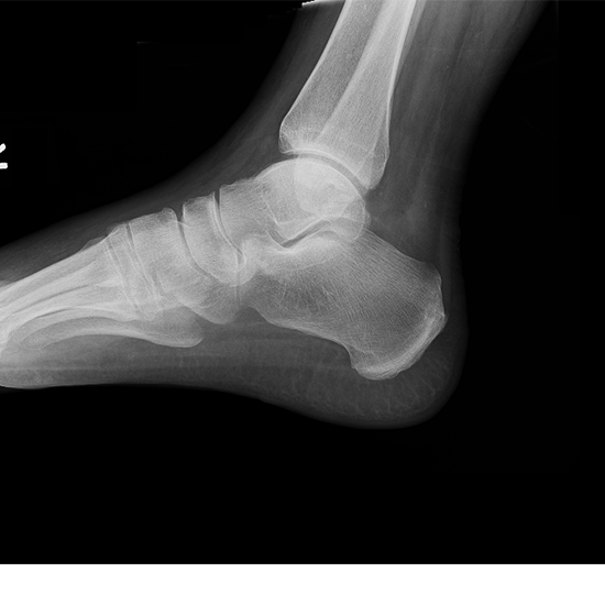X-ray Left Heel Lateral