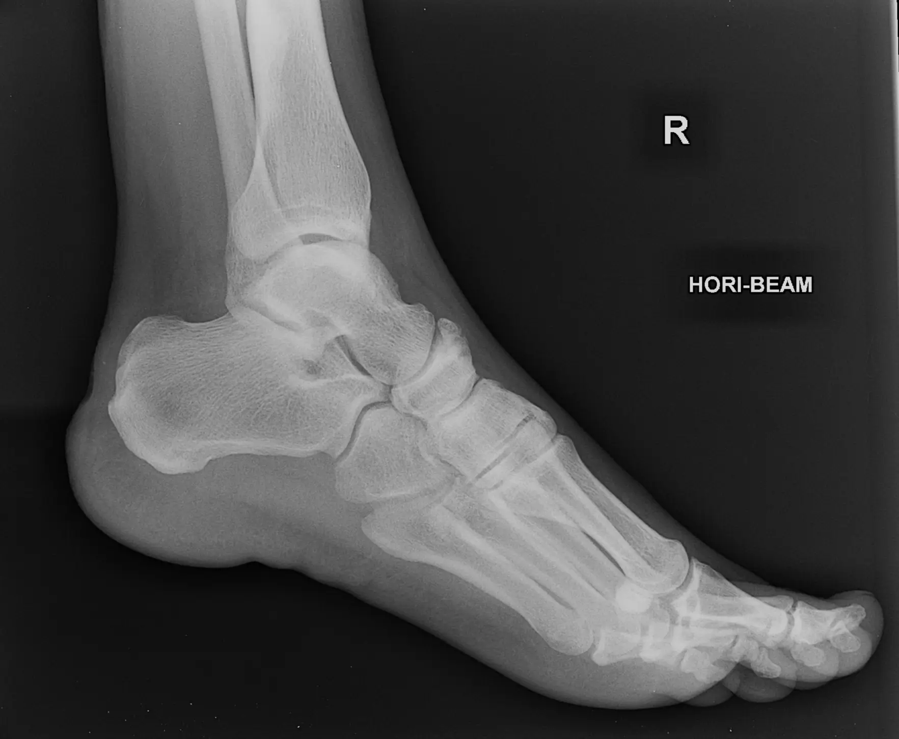 X-ray Left Heel Lateral/Axial