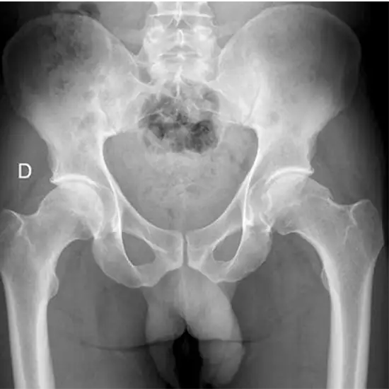 X-ray Left Hip AP