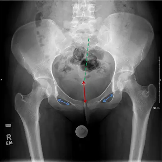 X-ray Left Hip Joint AP View