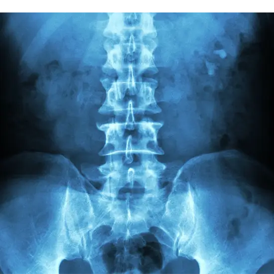 x-ray abdomen