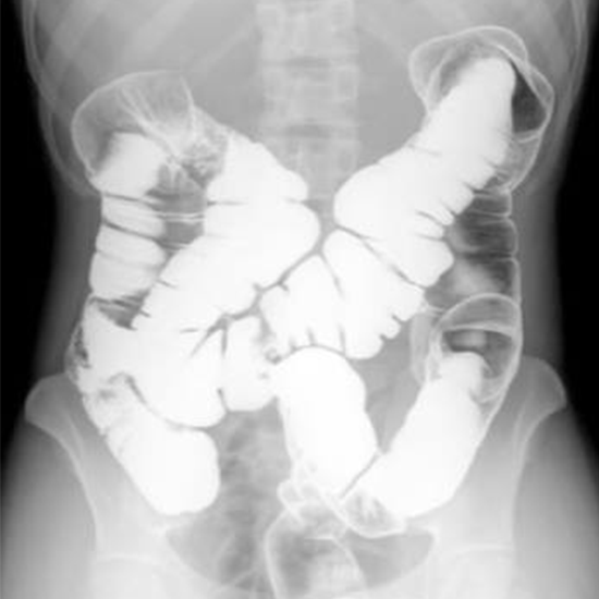 x-ray barium enema single contrast