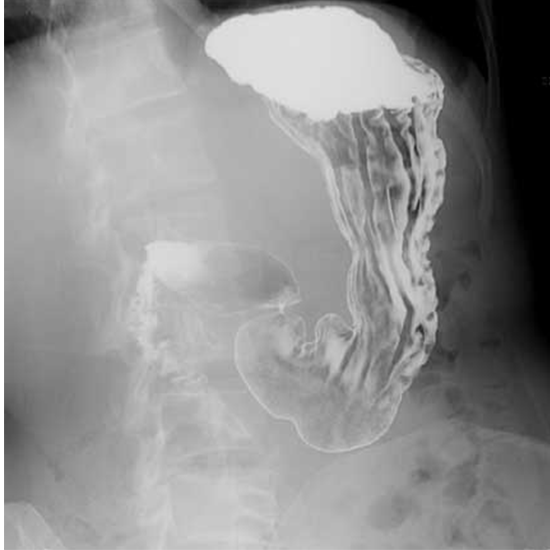 x-ray barium meal upper gastrointestinal
