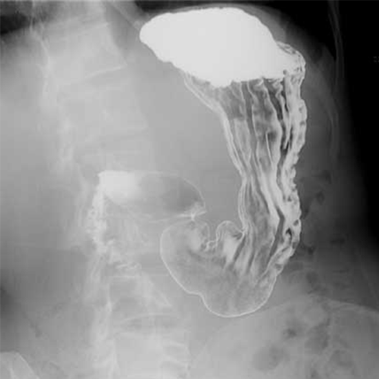 x-ray barium upper gastrointestinal & follow through