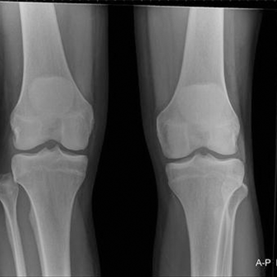 x-ray bilateral knee ap view