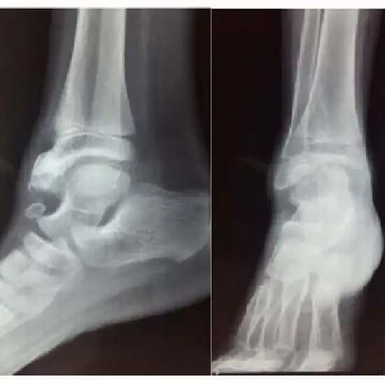 X-ray Both Ankle Lateral