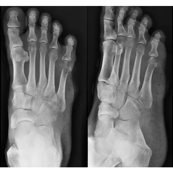X-ray Both Big Toe AP & LAT