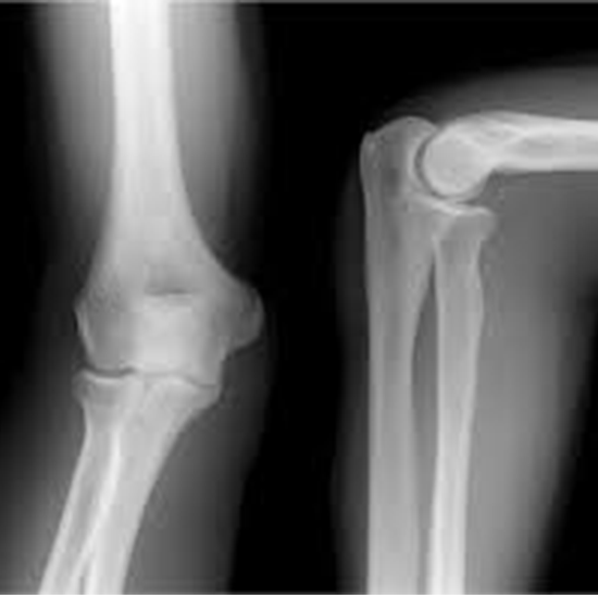 X-Ray Both Elbow AP & LAT