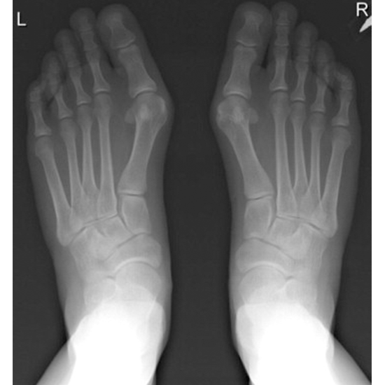 x-ray both feet ap and lat