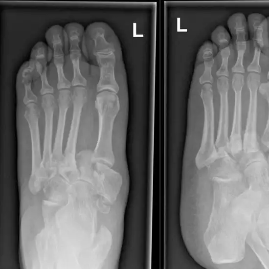 X-ray Both Feet LAT View