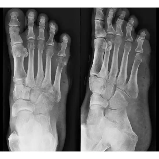 X-ray Both Foot AP & Oblique