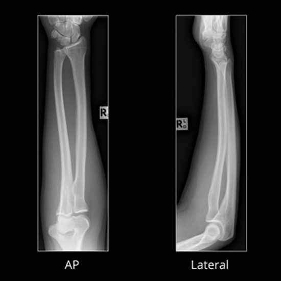 X-ray Both Forearm AP View