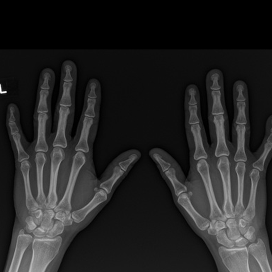X-ray Both Hand AP View