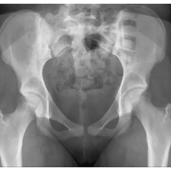 X-ray Both Hip Joint AP