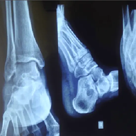 X-ray Both Heel AP/ LAT