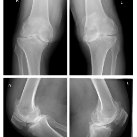 X-ray Both Knee AP & LAT