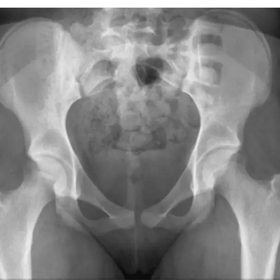 X-ray Both Hip LAT