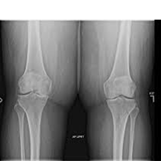 X-ray Both Knee AP View