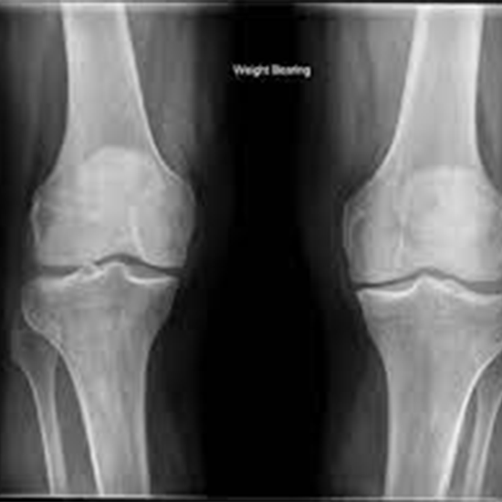 X-ray Both Knee Standing AP & LAT Views