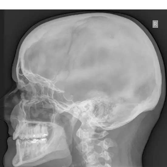 x-ray both mastoid lat oblique