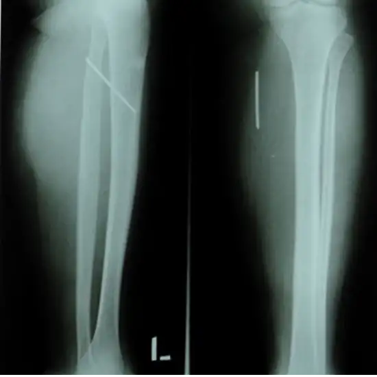 X-ray Both Leg AP & LAT