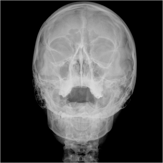 X-ray Both Optic Foramen