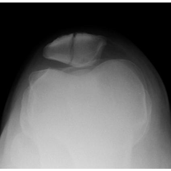 X-ray Both Patella Axial