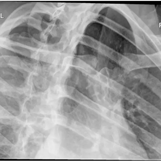 X-ray Both Sternoclavicular Joint
