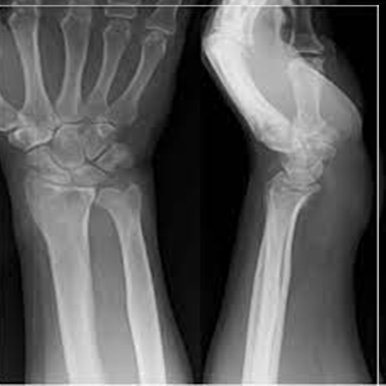 X-ray Both Wrist AP View