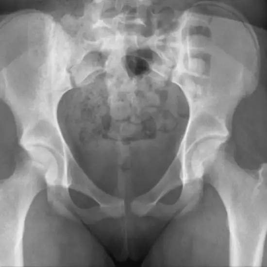 X-ray Both Upper Femur-Hip AP/Lat