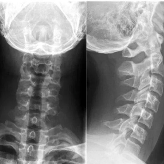 X-ray Cervical AP, Lat, Both Oblique