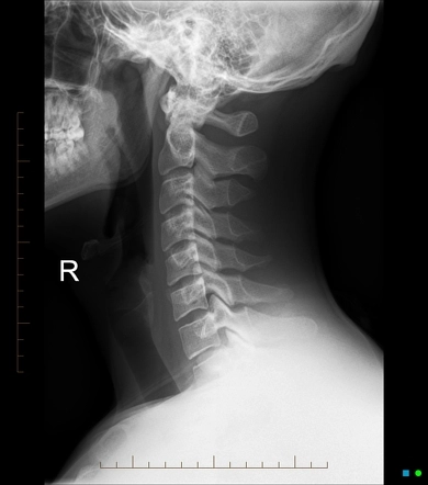 X-ray Cervical Lateral