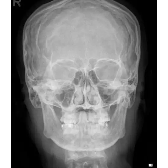 X-ray Caldwell View